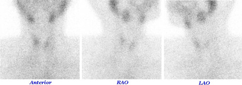 Subacute thyroiditis following COVID-19 vaccination Issue 10, 2021
