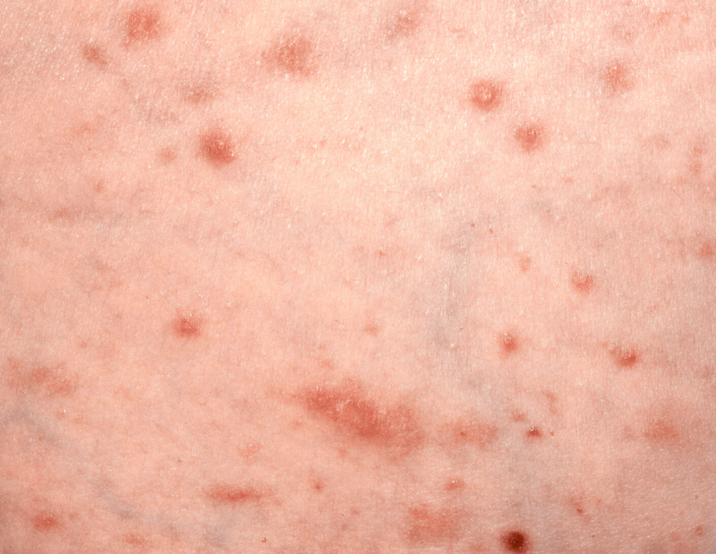 Lichenoid cutaneous skin eruption and associated systemic inflammatory response following Pfizer-BioNTech mRNA COVID-19 vaccine administration Issue 11, 2021