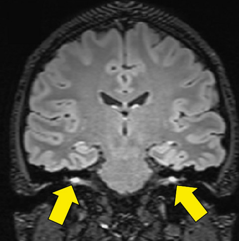 Bilateral facial nerve palsy associated with COVID-19 and Epstein–Barr virus co-infection Issue 1, 2021