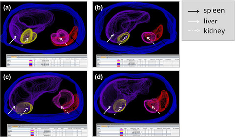 Immunosuppression and cardiovascular dysfunction in patients with severe versus mild coronavirus disease 2019: a case series Issue 10, 2020