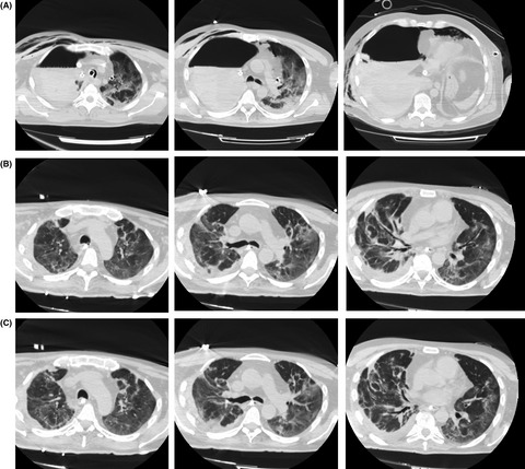 Multidisciplinary approach to a septic COVID-19 patient undergoing veno-venous extracorporeal membrane oxygenation and receiving thoracic surgery Issue 10, 2021